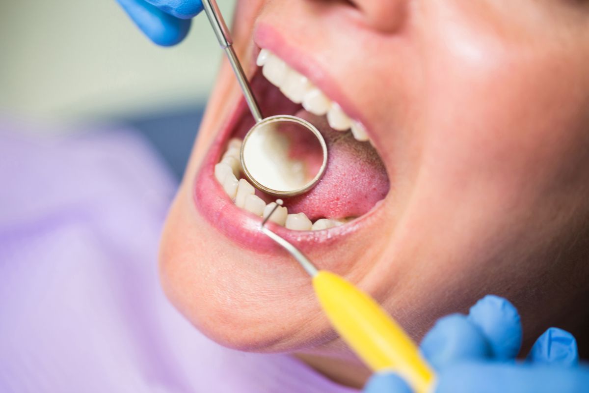 Próchnica – etapy rozwoju (od plamy po leczenie kanałowe)